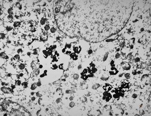 M,66y. | siderosomes